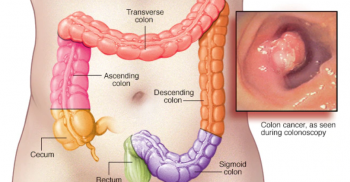 কোলন ক্যান্সার প্রতিরোধে করণীয়